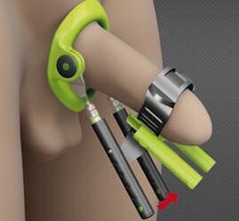 Errehabilitazioa zakila handitzeko eragiketa baten ondoren