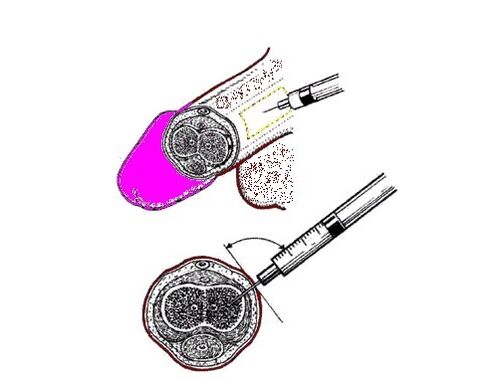 petrolio gelatina zakilean ponpatzea handitzeko modu gisa